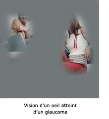 Le glaucome